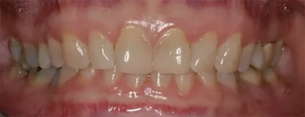 closeup of female patient's teeth before extraction for help with TMJ and jaw pain with Dr. Raman in Kansas City