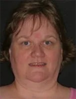 Rachael after treatment