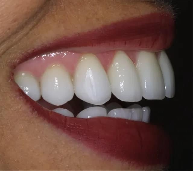 profile view of a woman's teeth after treatment with tmj and sleep dentist Dr. Raman