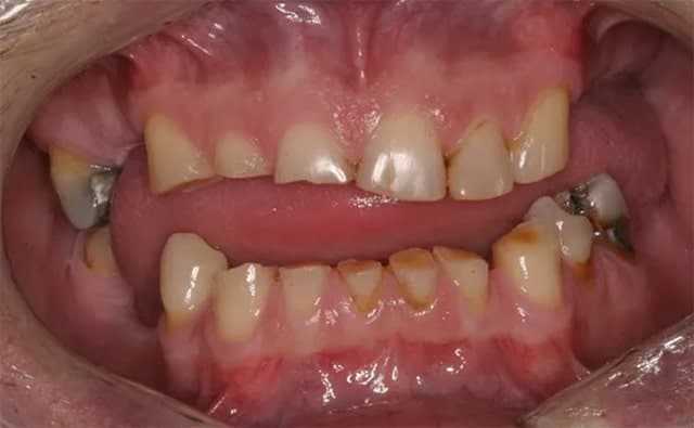closeup of teeth before treatment with Dr. Raman, TMJ and sleep apnea dentist in Kansas CIty