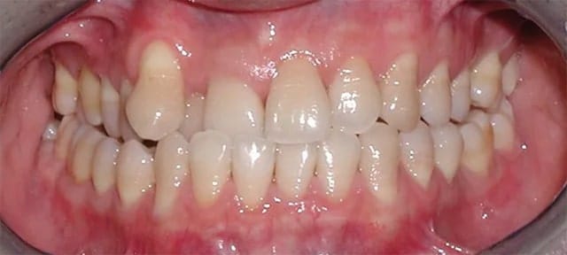 closeup photo of a patient of tmj and sleep dentist Dr. Raman before beginning treatment