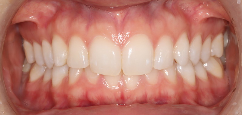 Tatum’s Journey to a Pain-Free Life and Restful Sleep